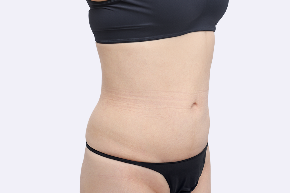 복부 지방흡입 후