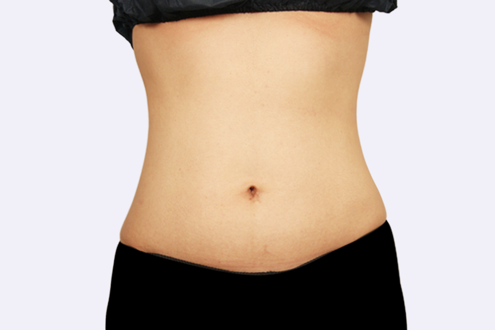 복부 라인 후