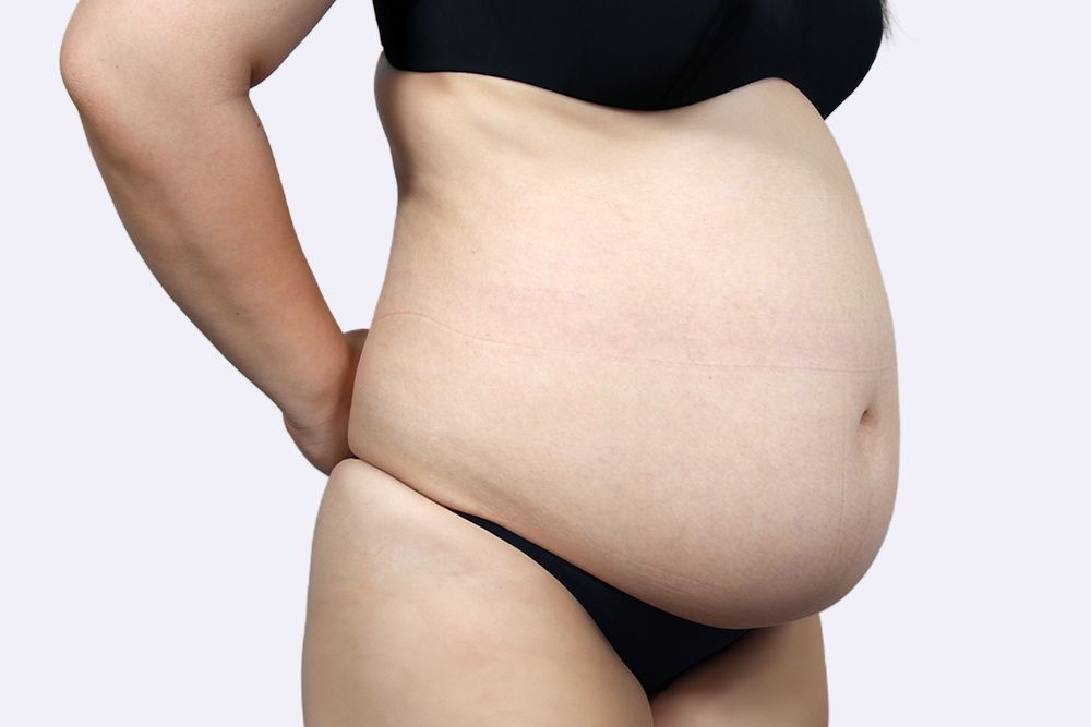 복부 지방흡입 전