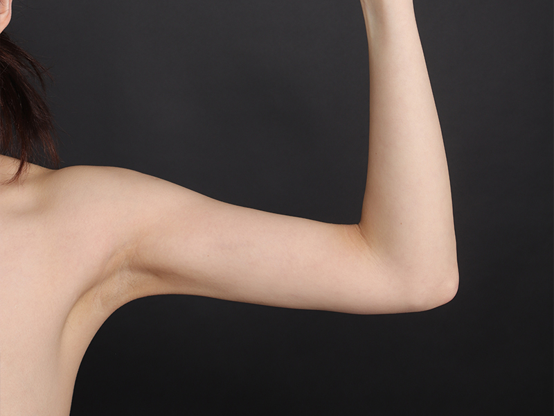 After arm liposuction