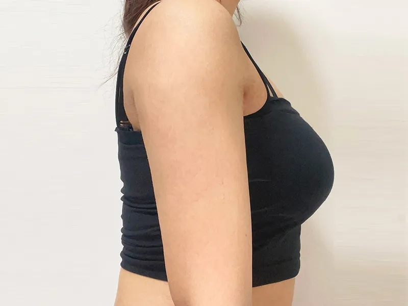 手臂吸脂 术后