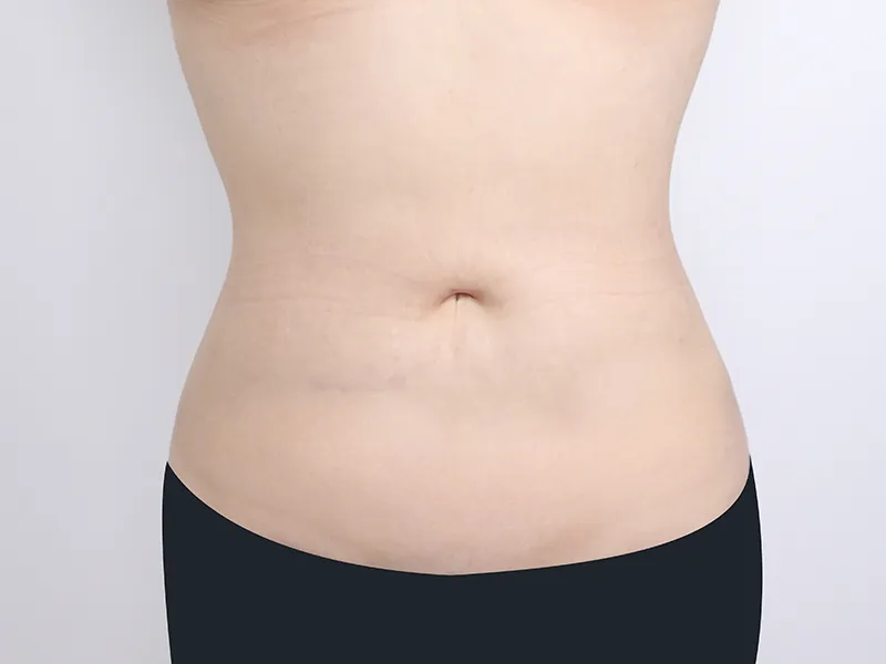 腹部吸脂 术后