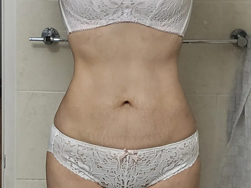 腹部吸脂 术后