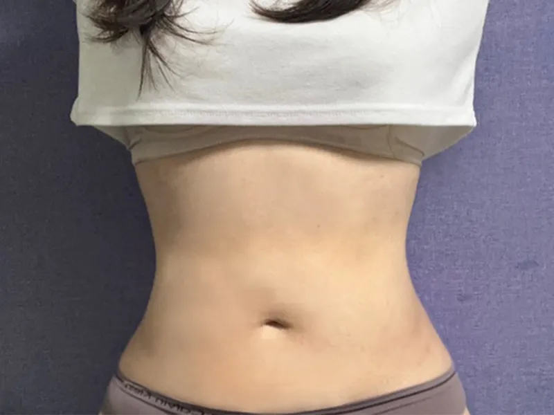 腹部吸脂 术后