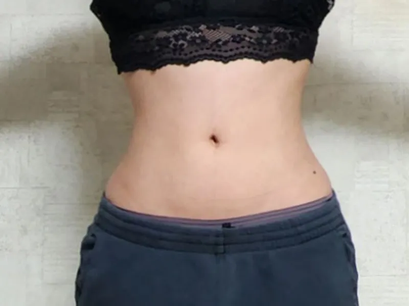 腹部吸脂 术后