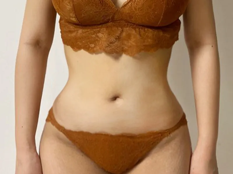 腹部吸脂 术后