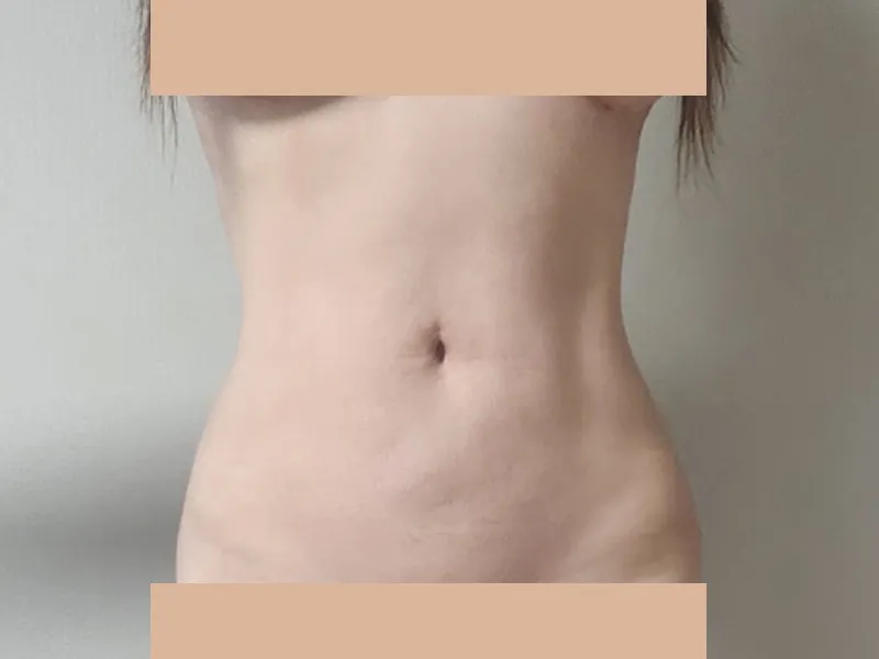 腹部吸脂 术后