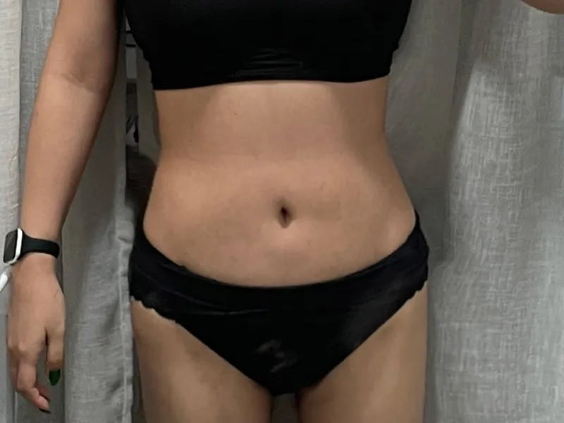 腹部吸脂 术后