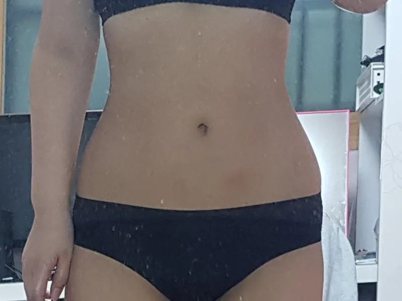 腹部吸脂 术后