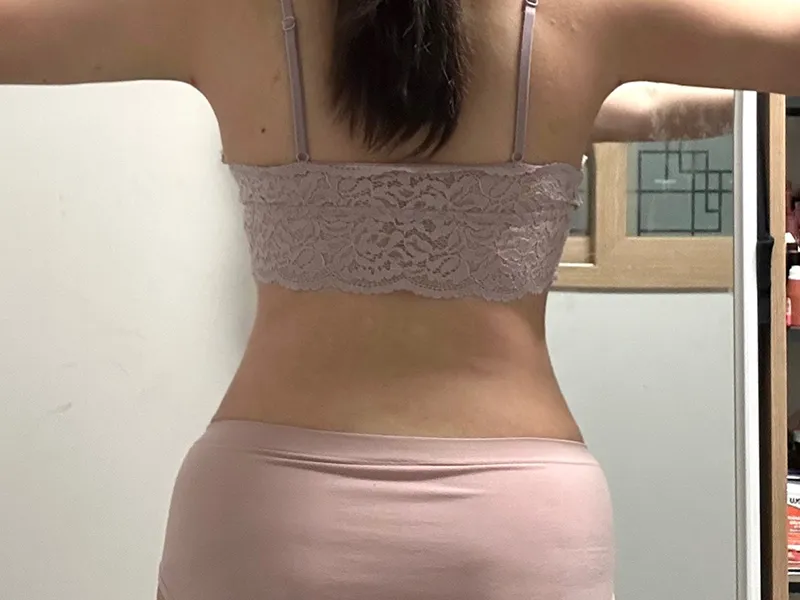 腹部吸脂 术后