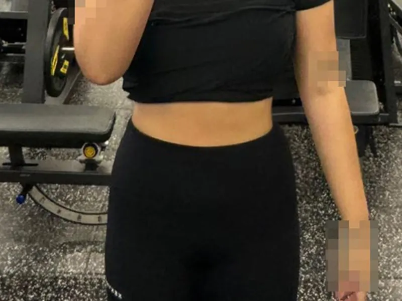 腹部吸脂 术后