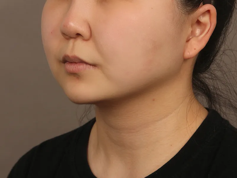 面部吸脂 术后
