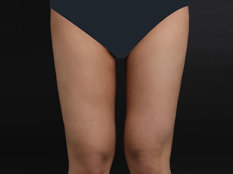 大腿吸脂 术后