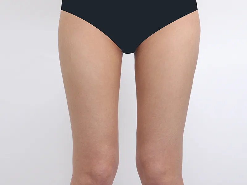 大腿吸脂 术后
