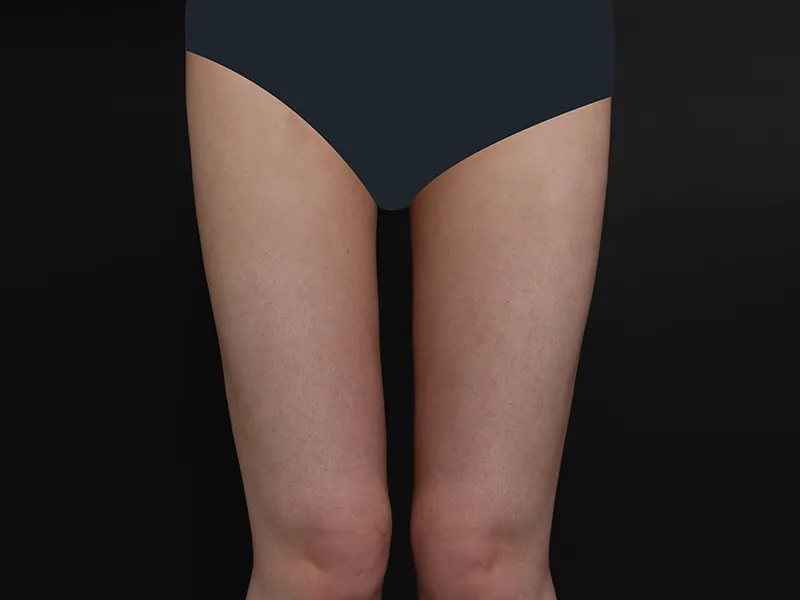 大腿吸脂 术后