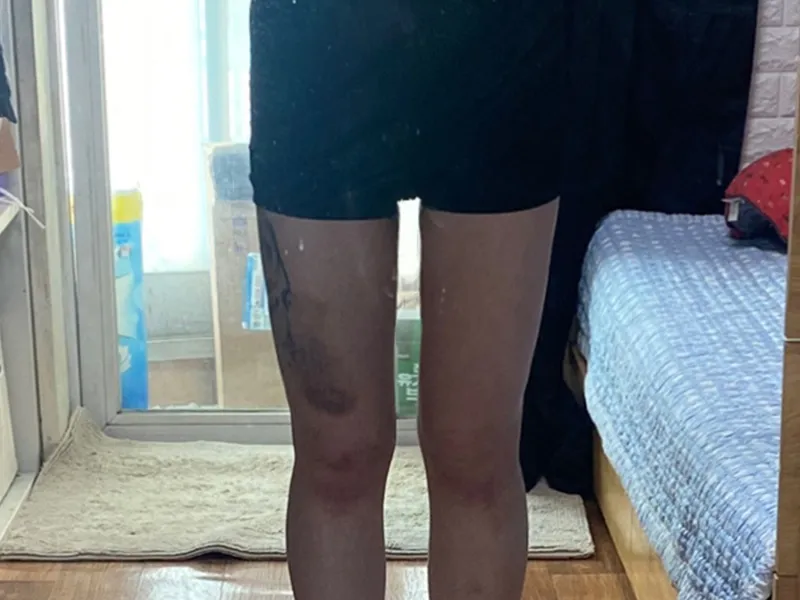 大腿吸脂 术后