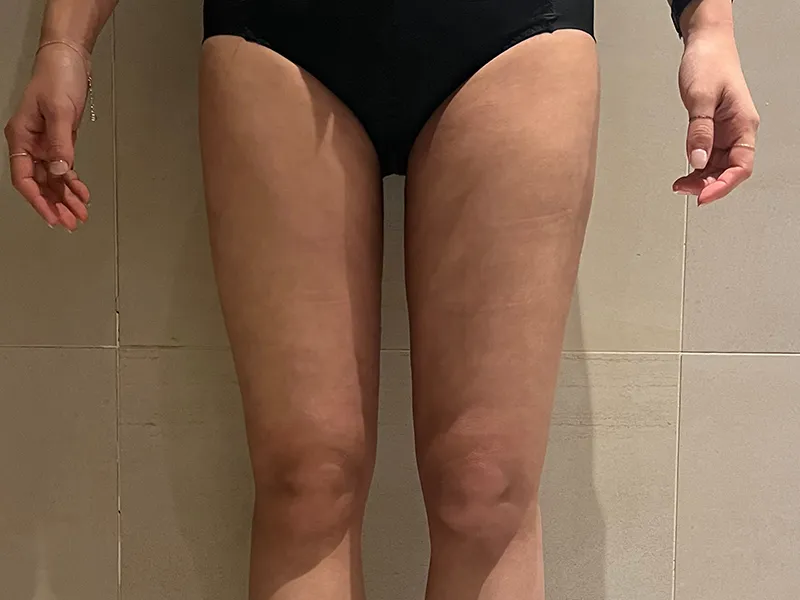 大腿吸脂 术后