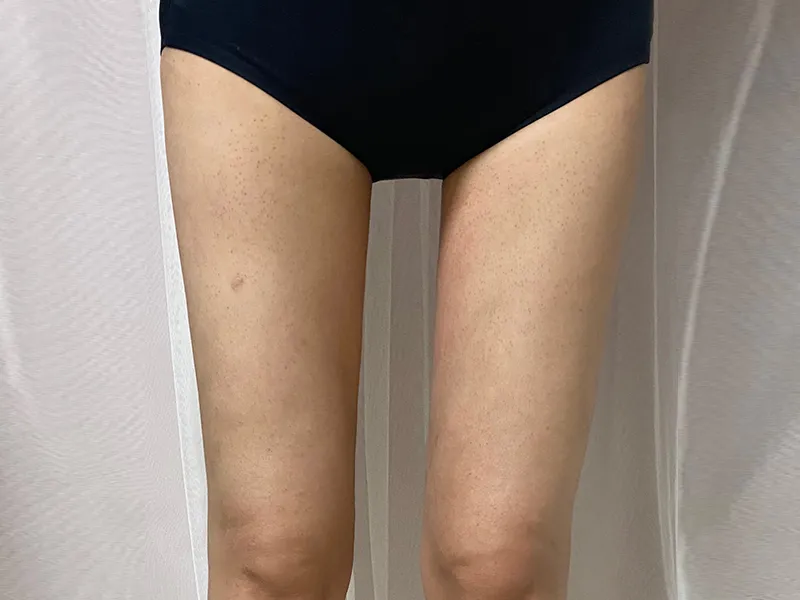 大腿吸脂 术后