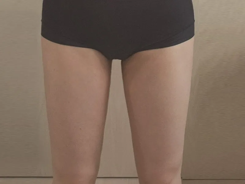 大腿吸脂 术后