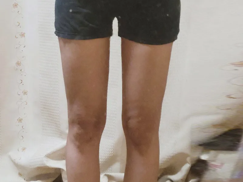 大腿吸脂 术后