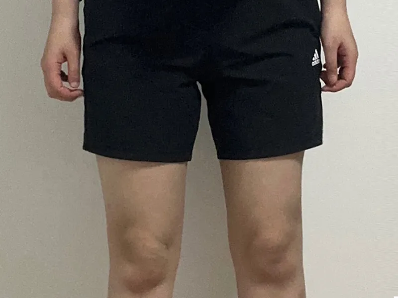 大腿吸脂 术后