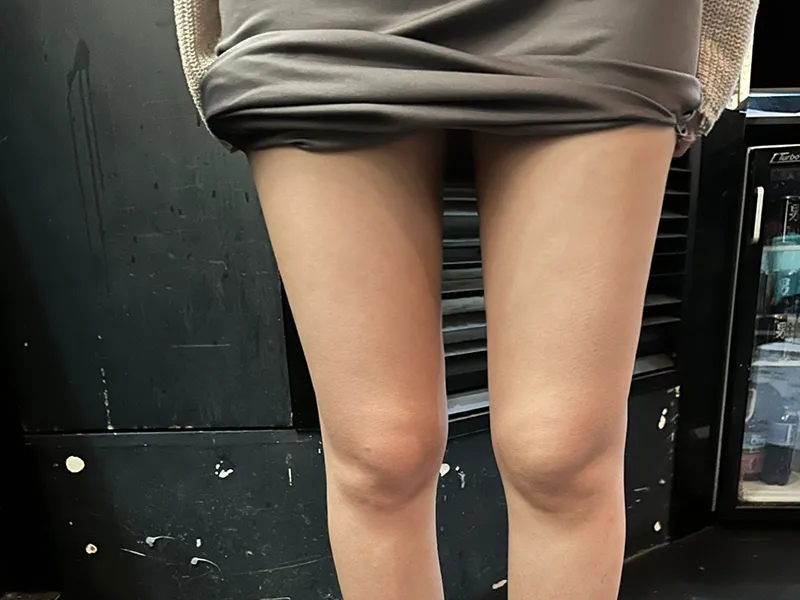 大腿吸脂 术后