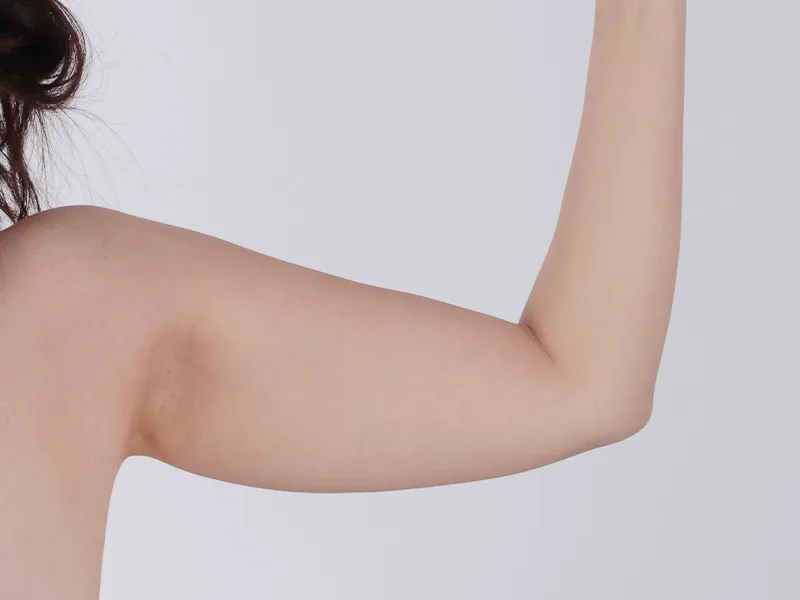 Before full arm liposuction