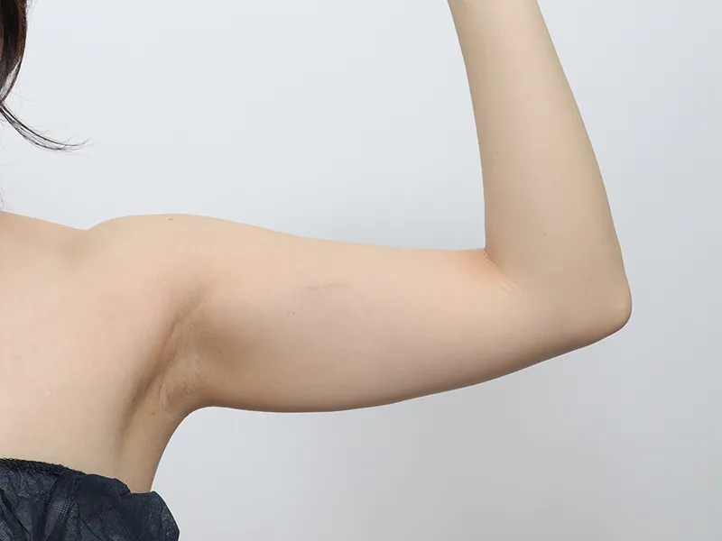 Before arm liposuction
