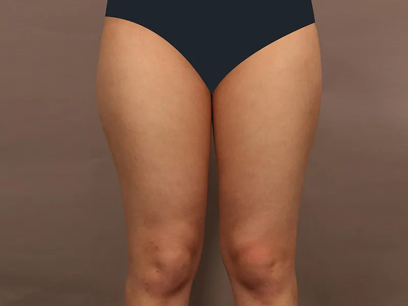 大腿吸脂 术前