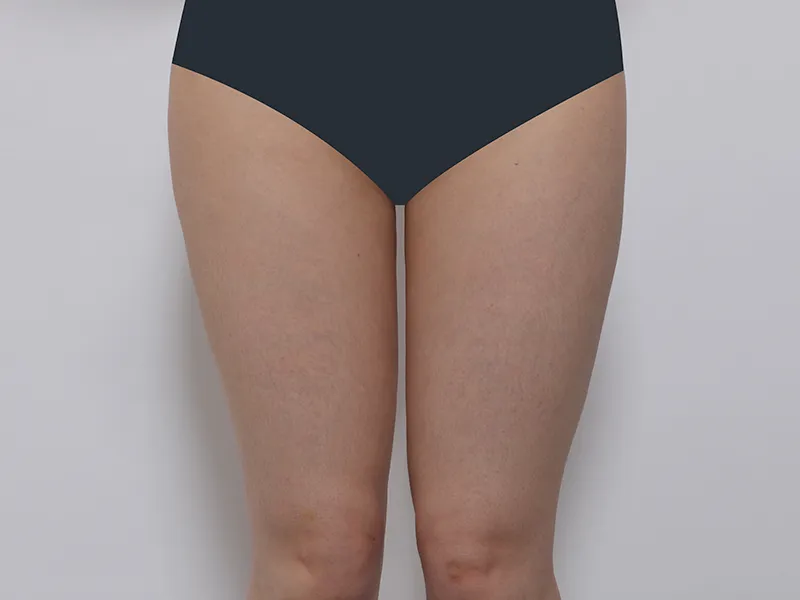 大腿吸脂 术前