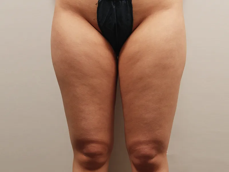 大腿吸脂 术前
