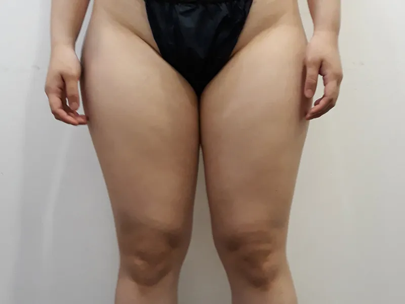 大腿吸脂 术前