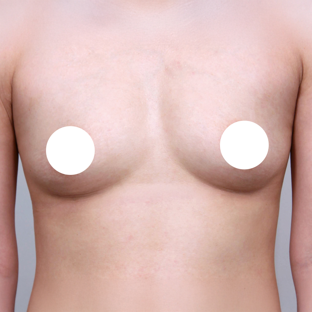 Case 03 수술 전 (참고)