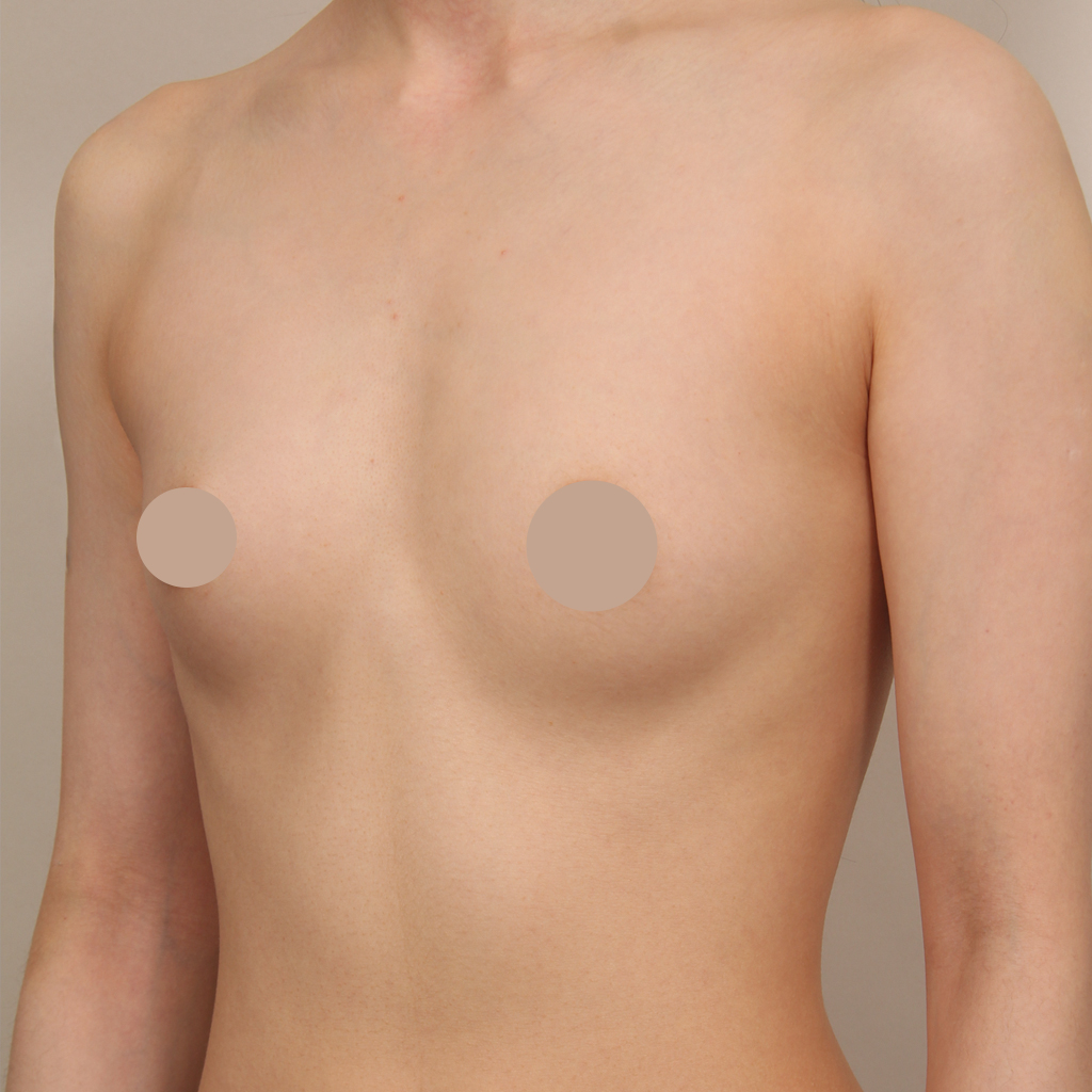 4D 가슴성형 전 사례 5