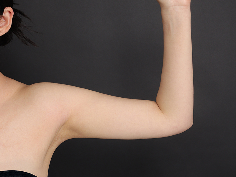 二の腕脂肪吸引 術後