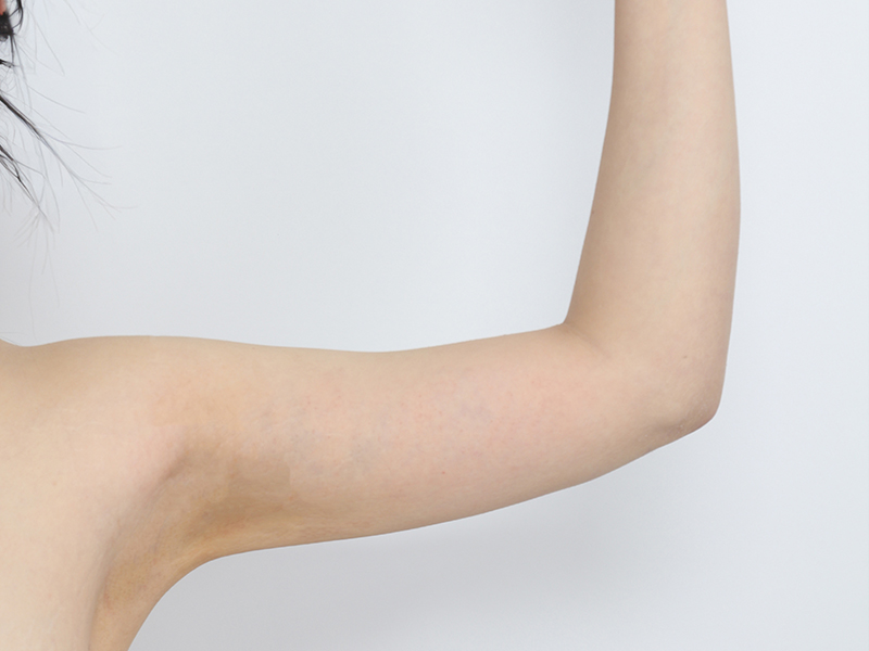 二の腕脂肪吸引 術後