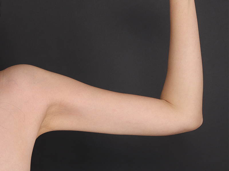 팔 전체 지방흡입 후