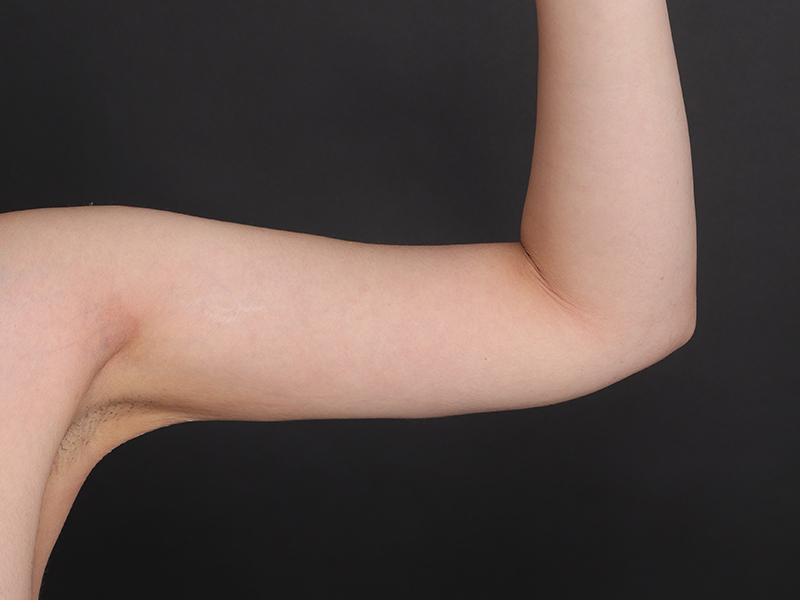 二の腕脂肪吸引 術後