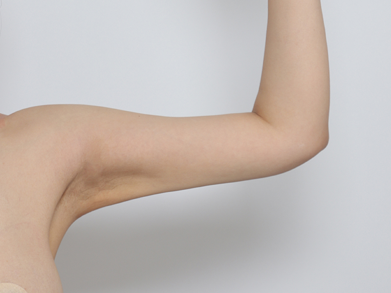 二の腕脂肪吸引 術後