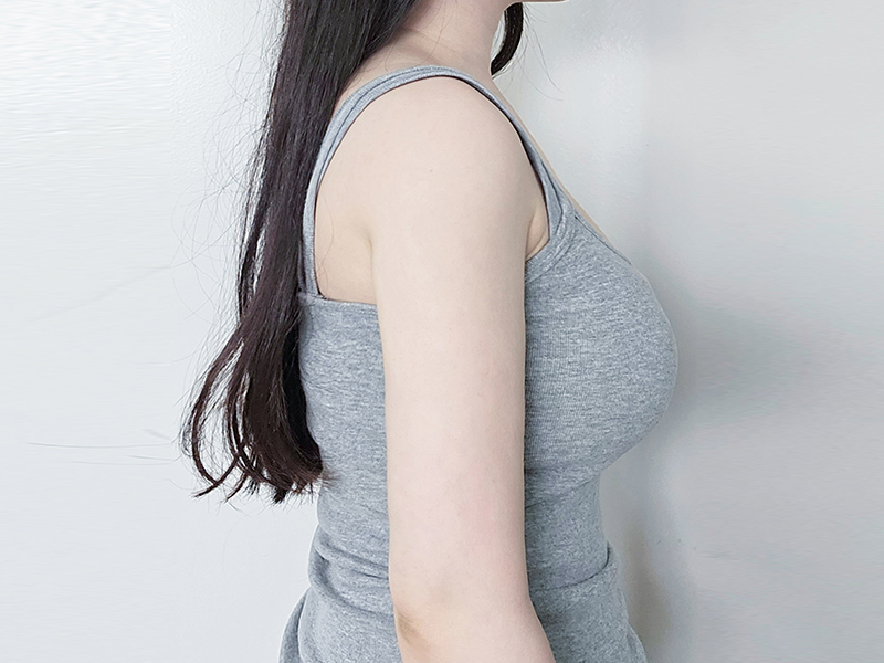 二の腕脂肪吸引 術後