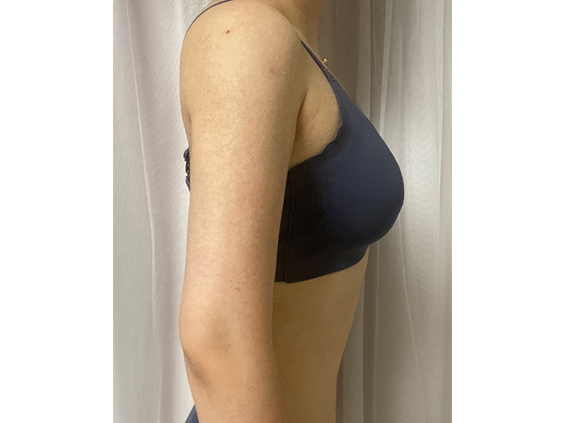 二の腕脂肪吸引 術後