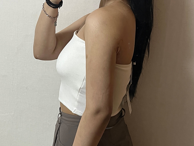 二の腕脂肪吸引 術後