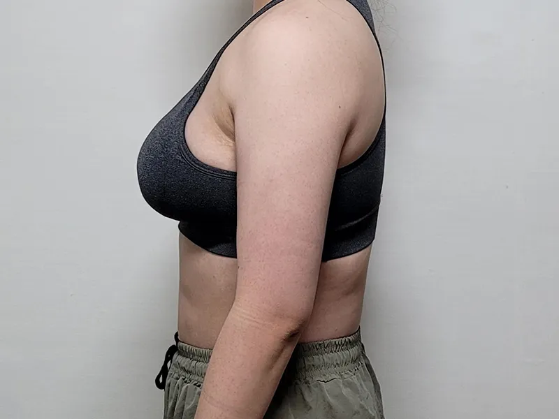 二の腕脂肪吸引 術後