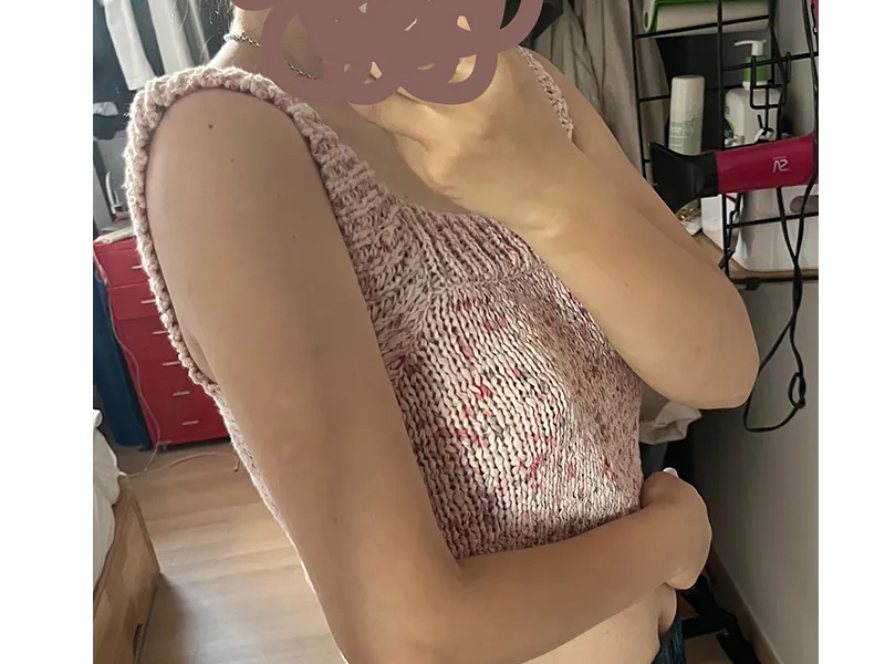 二の腕脂肪吸引 術後