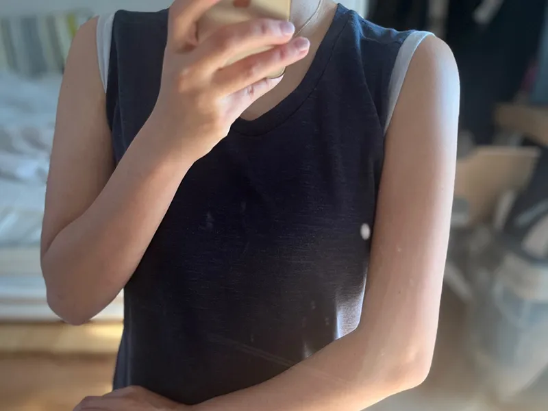 二の腕脂肪吸引 術後