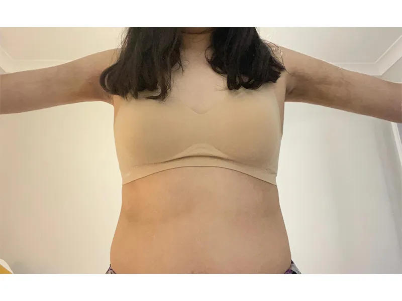 二の腕脂肪吸引 術後