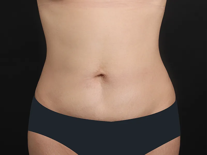 腹部脂肪吸引 術後