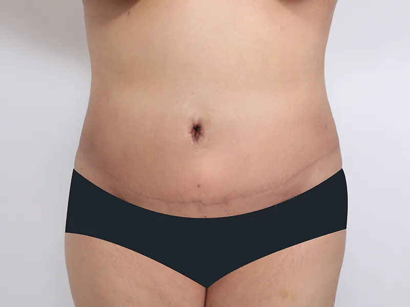 腹部形成術 術後