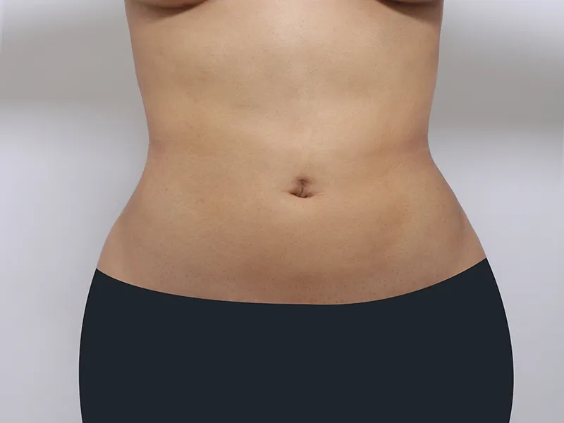 腹部脂肪吸引 術後