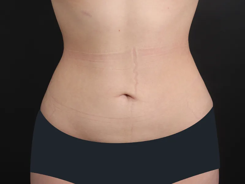 腹部脂肪吸引 術後